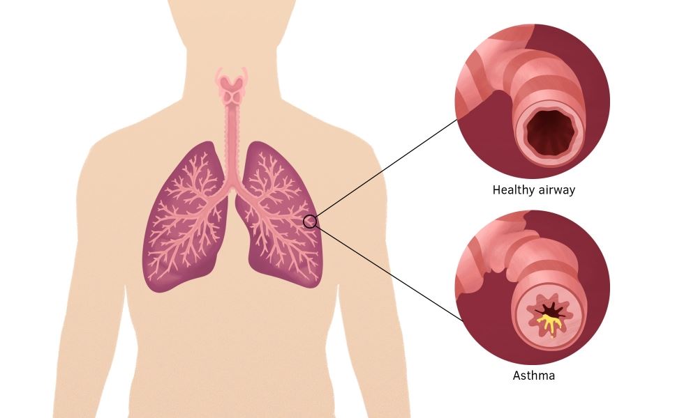 درمان آسم در طب سنتی